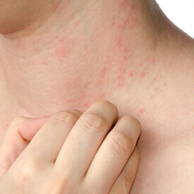 Eczema Treatment 
