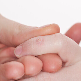 Wart Treatment