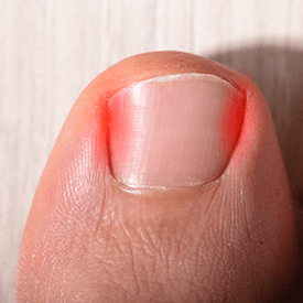 Toenail Removal