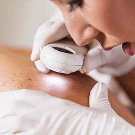 Mole Removal